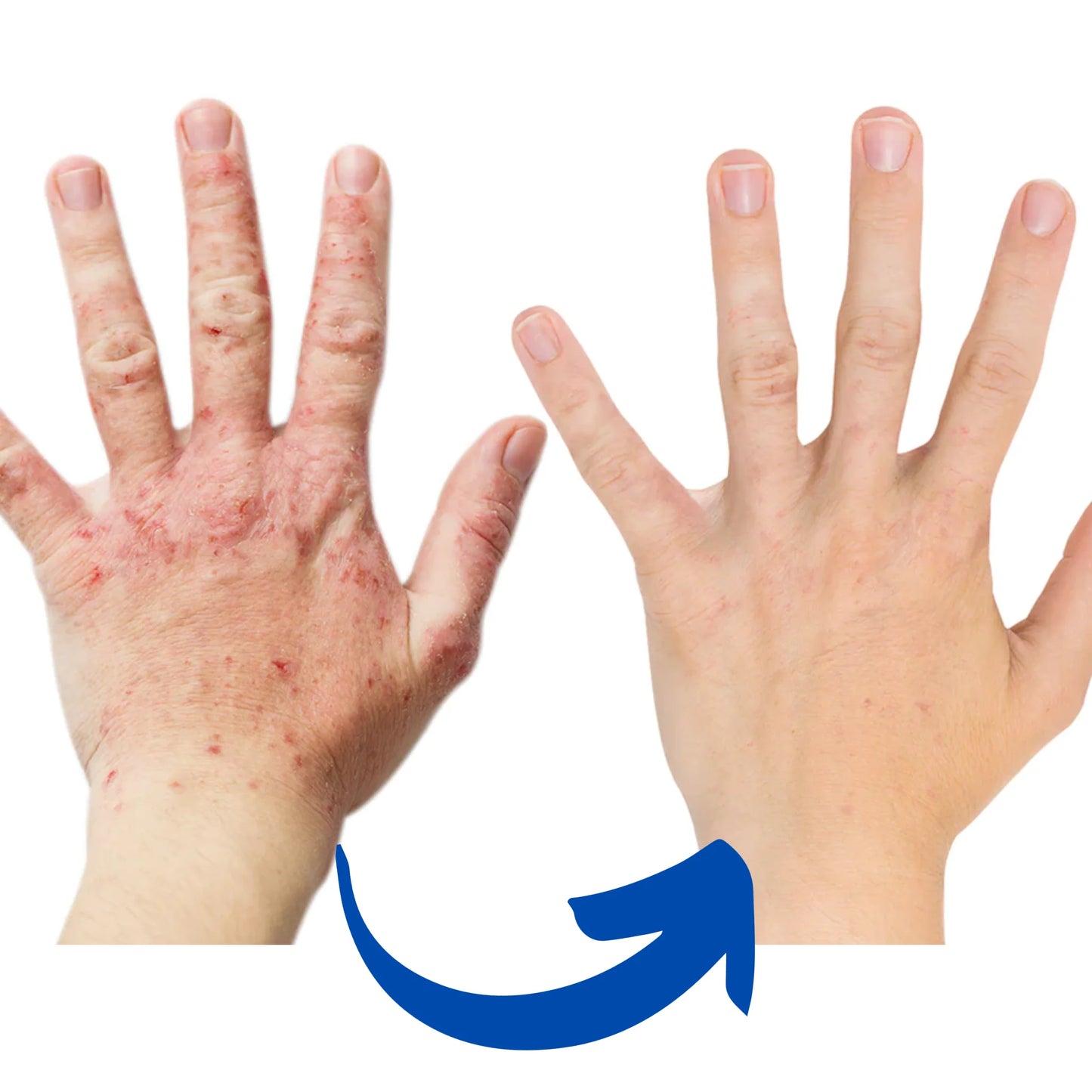 Infrared Therapy Gloves 660nm Rechargeable Ergonomic Fit