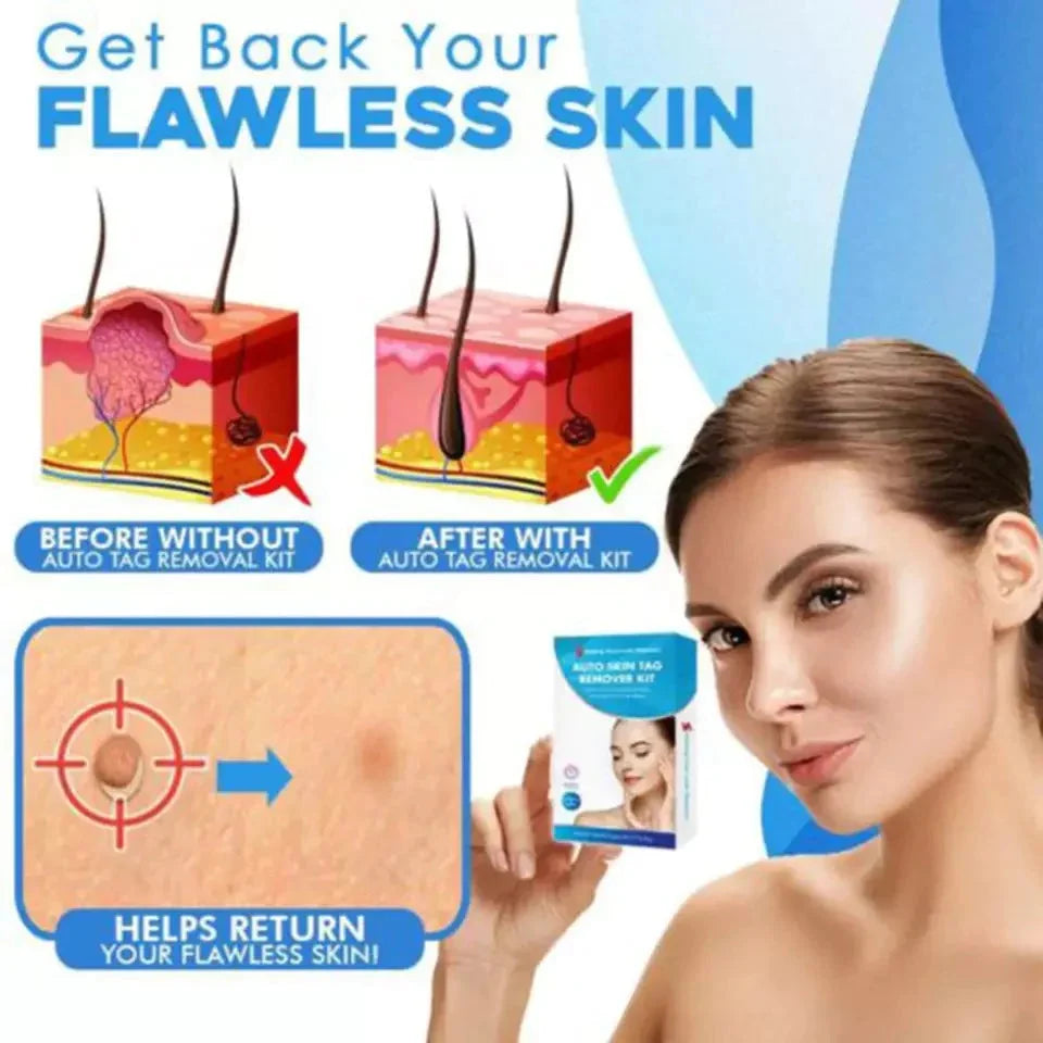 Skin Tag Removal Kit Pain-Free Auto Applicator 44 Bands