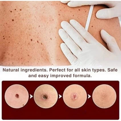 Skin Tag & Wart Remover Pen Precision Brush Tip