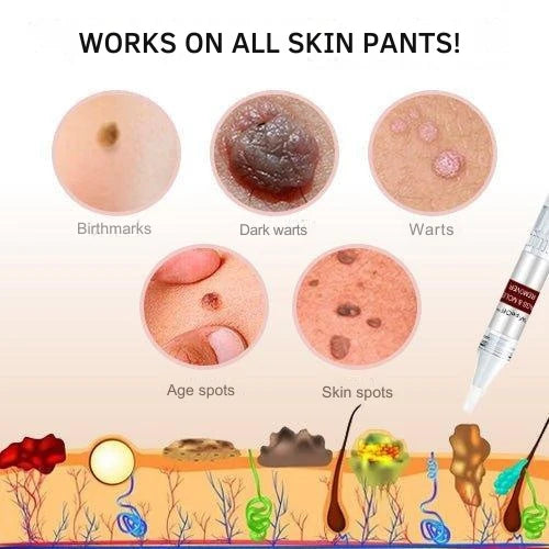 Skin Tag & Wart Remover Pen Precision Brush Tip