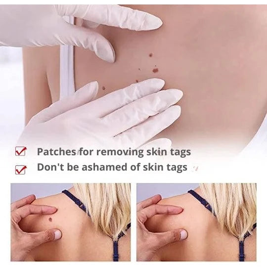 Skin Tag & Wart Remover Pen Precision Brush Tip