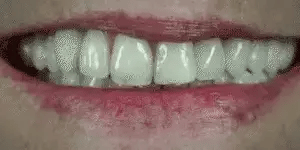 Snap-On Veneers Moldable Custom Fit Upper & Lower