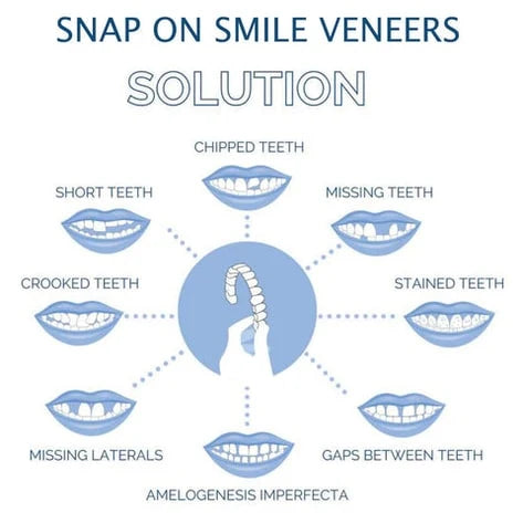 Snap-On Veneers Upper & Lower Flexible Molded Fit